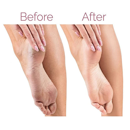 Electric Foot Callus Remover | مزيل كالو القدم الكهربائي